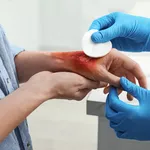 Burned in an accident? Seek compensation with the help of an injury lawyer.